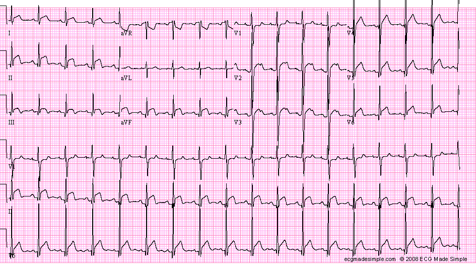 Case 33 A 21 Year Old Man With Chest Pain ECG Made Simple