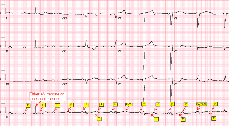 Case 155: A 69-Year-Old Woman in the Emergency Department - ECG Made Simple
