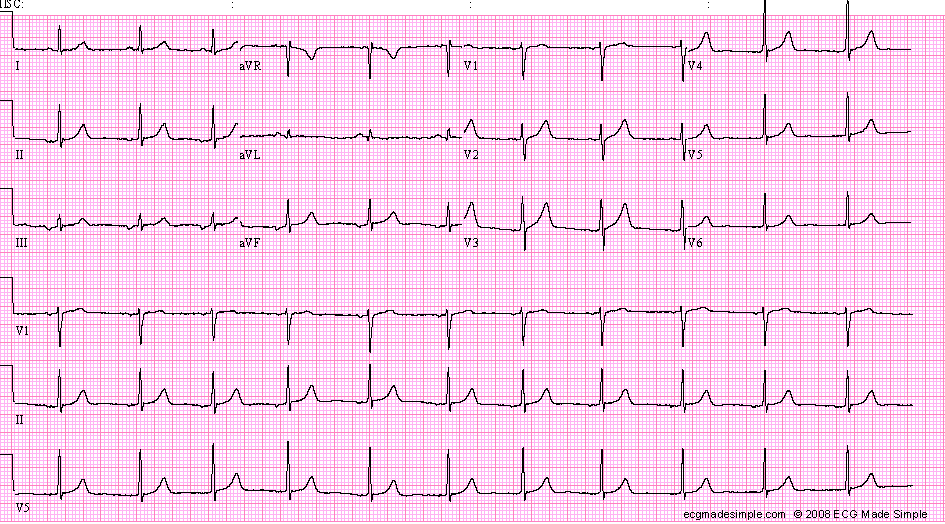 ectopic atrial tach