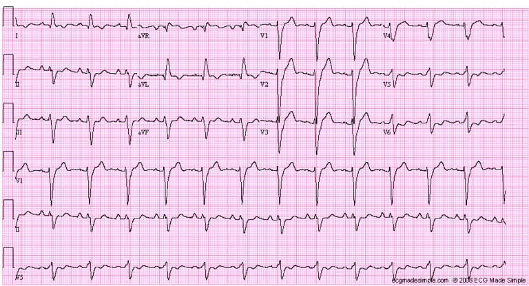 Case 60: A 41-year-old Man With Lupus - Ecg Made Simple