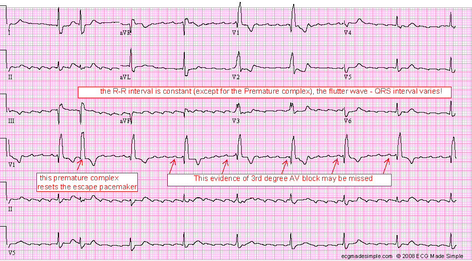 Case 154: A 61-Year-Old Man with Infective Endocarditis - ECG Made Simple