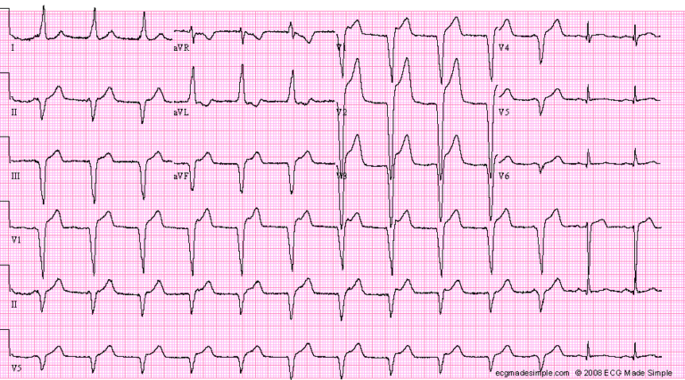 Case 152: A 66-Year-Old Woman with Chest Pain - ECG Made Simple