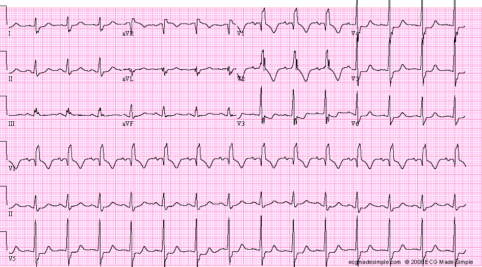 Case 111: A 69-Year-Old Diabetic Woman for Routine Assessment - ECG ...