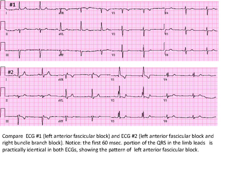 Case 149: A 74-Year-Old Man Scheduled for Cardiac Surgery - ECG Made Simple