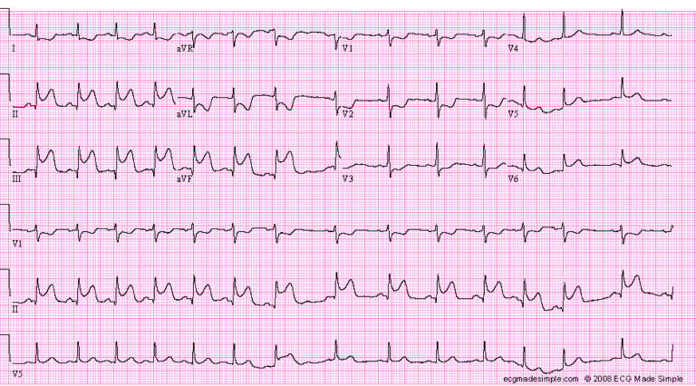 Inferior-Posterior Infarction Archives - ECG Made Simple