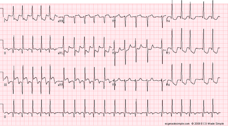 Acute Right Ventricular Infarction Archives - ECG Made Simple