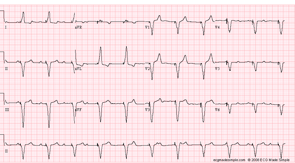 Case 83: A 34-Year-Old Man with Endocarditis - ECG Made Simple