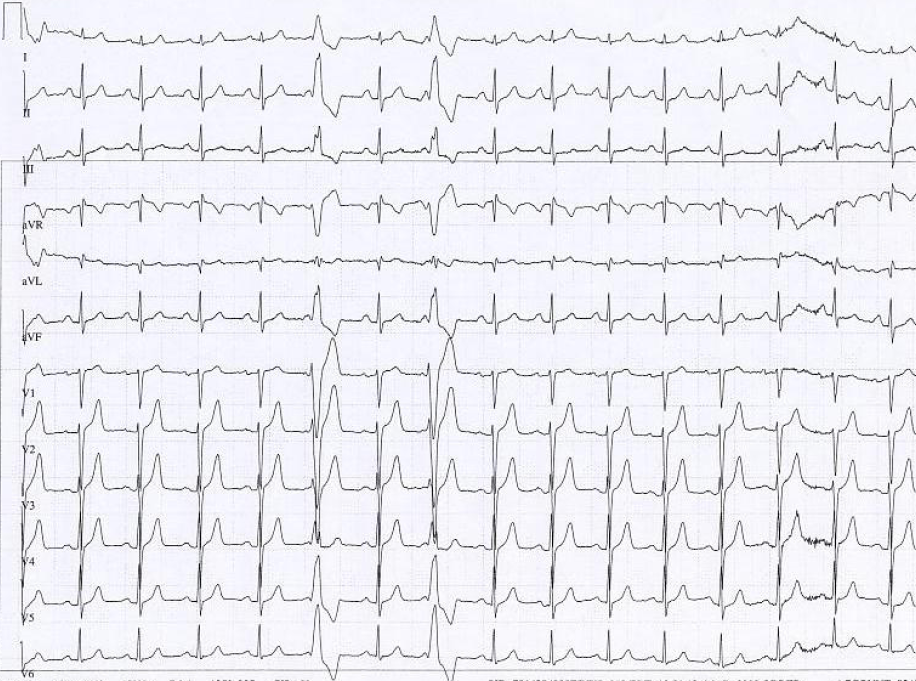 Palpitations Racgp Case 69: A 25-Year-Old Woman with Episodes of Palpitation - ECG Made Simple