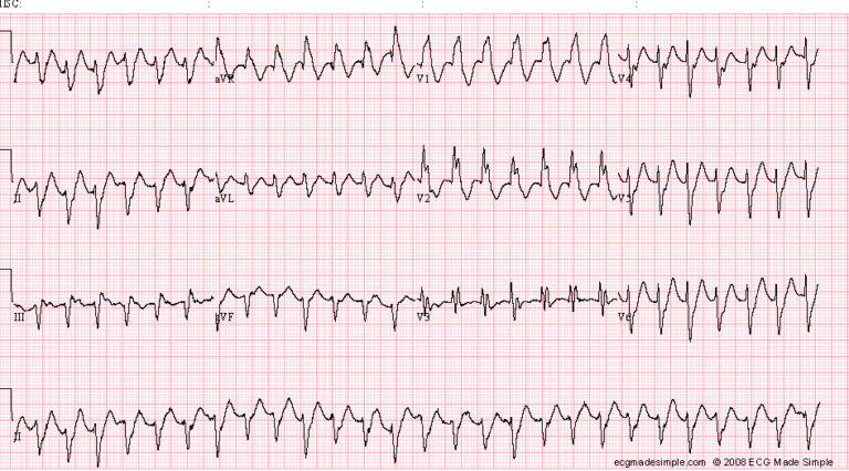 Case 62: A 53-Year-Old man with Palpitation and Faintness - ECG Made Simple