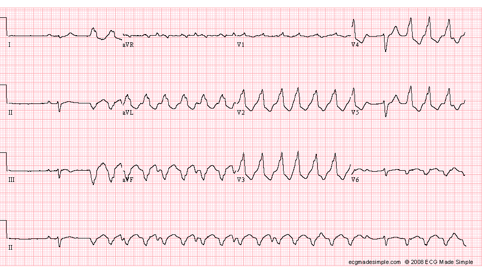 Case 61: A 63-Year-Old Woman with Dilated Cardiomyopathy - ECG Made Simple