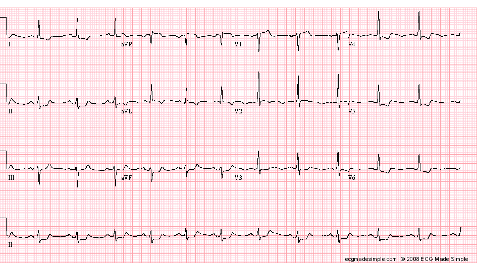 Case 60: A 58-Year-Old Man with Unstable Angina - ECG Made Simple