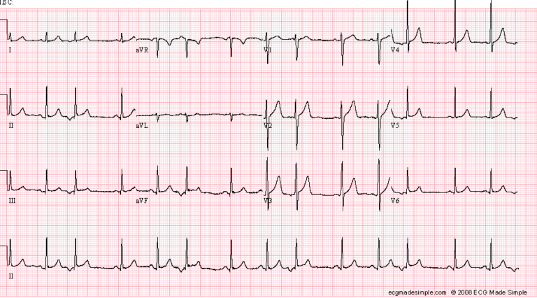 Palpitations Racgp Case 14: A 62-Year-Old Man with Palpitations - ECG Made Simple