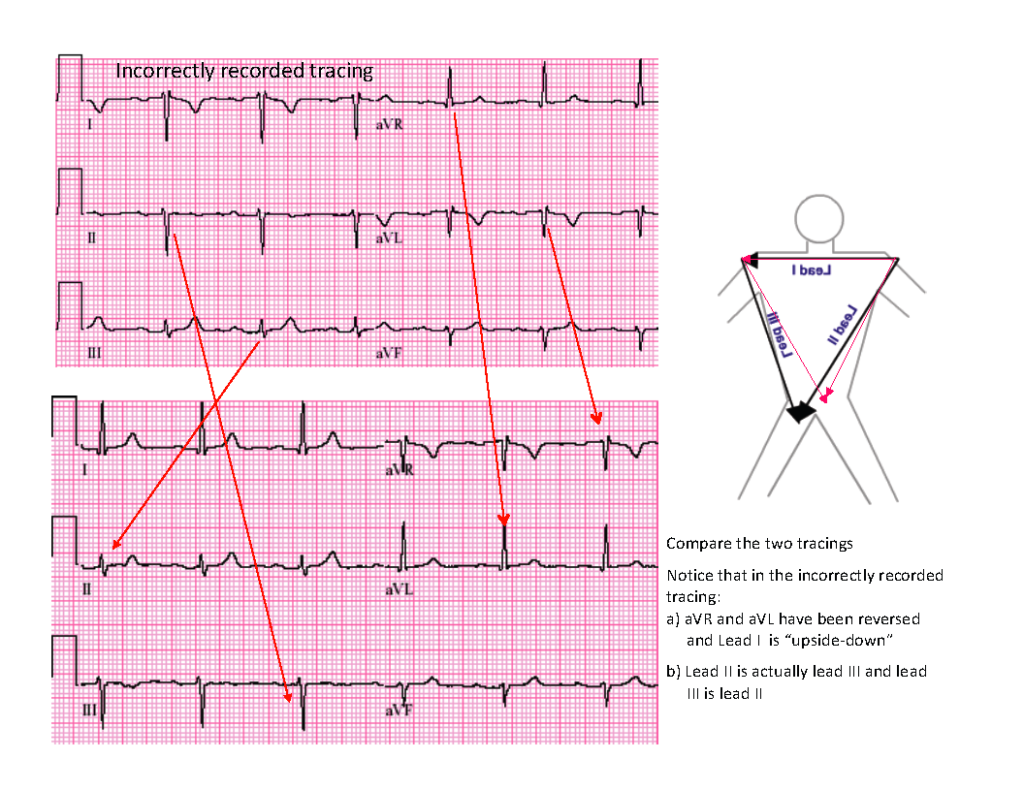 Case 18: A 56-Year-Old Woman in Cardiac Catheterization Lab - ECG Made ...