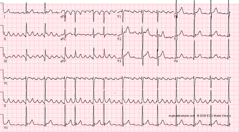 Palpitations Racgp Case 81: A 58-Year-Old Man with Paroxysmal Palpitations - ECG Made Simple