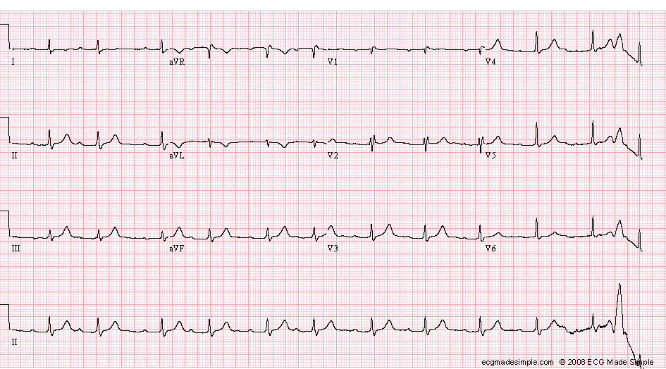 Case 35: A 39-Year-Old Man with Episodes of Paroxysmal Palpitation ...