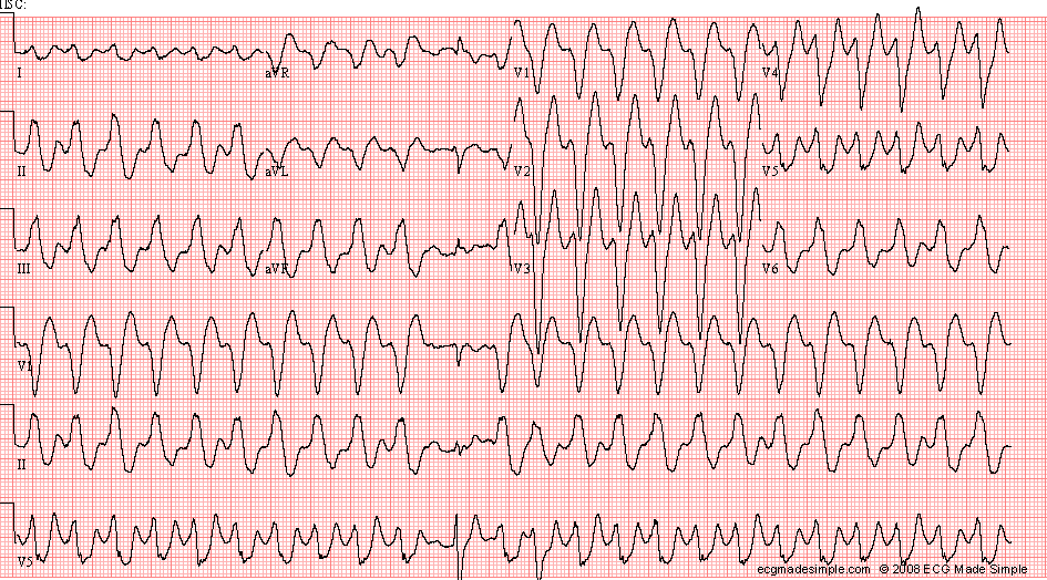 Case 29: A 48-Year-Old Man in the ER with Palpitations - ECG Made Simple