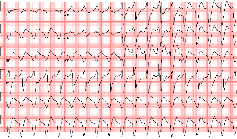 Case 100: A 66-Year-Old Man in the EP Clinic - ECG Made Simple