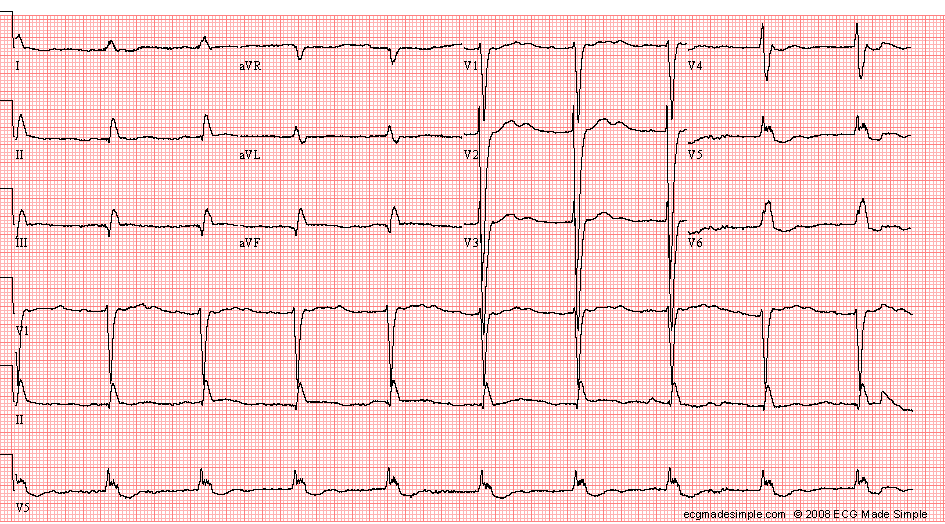 Case 100: A 66-Year-Old Man in the EP Clinic - ECG Made Simple