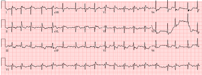 Case 17: A 70-Year-Old Woman in the Emergency Department - ECG Made Simple