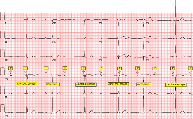 Case 97: A 68-Year-Old Woman in the ER - ECG Made Simple