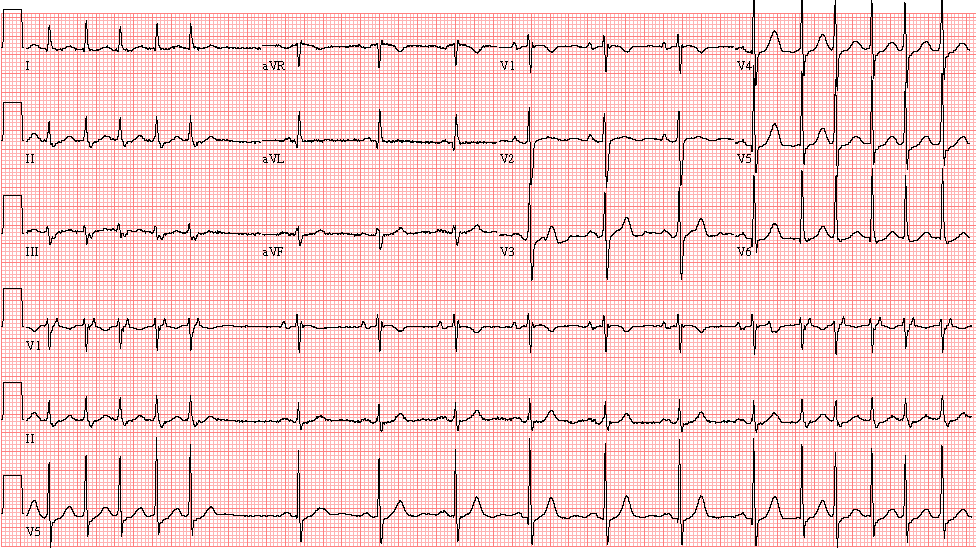 Case 26: An 88-Year-Old Woman in the Emergency Department - ECG Made Simple