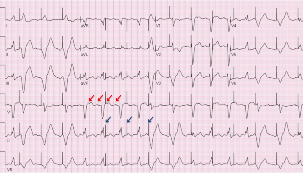 Case 5: A 68-Year-Old Man in the Emergency Room - ECG Made Simple