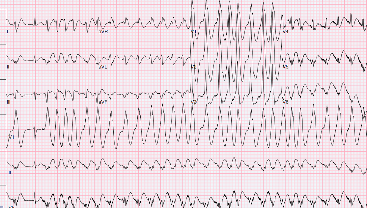 Palpitations Racgp Case 2: A 52-Year-Old Man in ER with Palpitations - ECG Made Simple