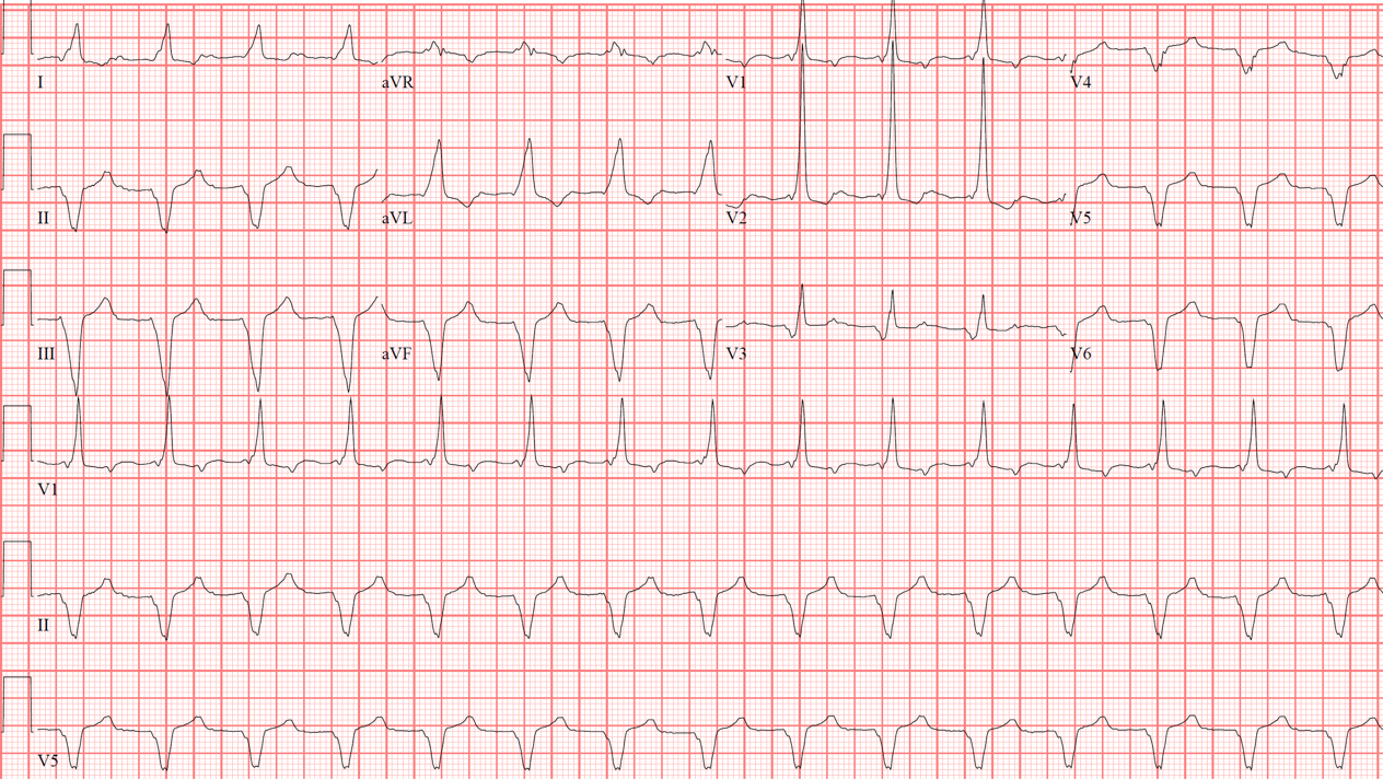 Case 1: A 53-Year-Old Man with Shortness of Breath - ECG Made Simple