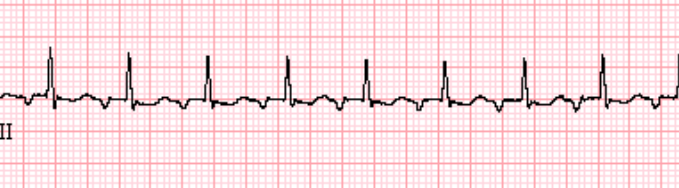 Atrial Tachycardia - ECG Made Simple