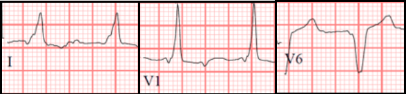 Intraventricular Conduction Delay - ECG Made Simple