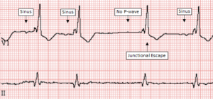 Junctional Escape Complex - ECG Made Simple