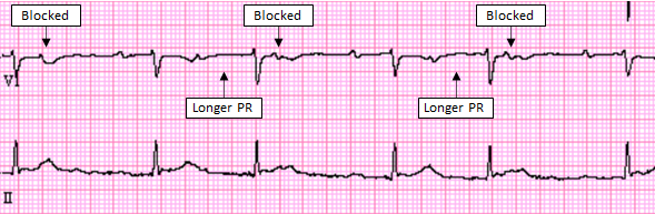 Mobitz I Second Degree AV Block - ECG Made Simple