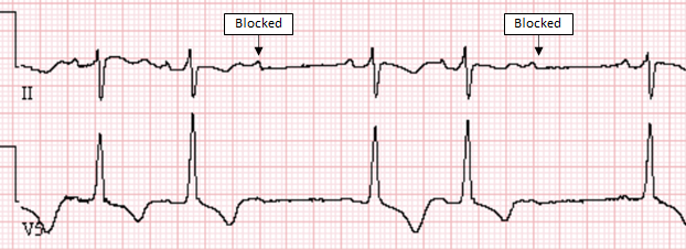 Mobitz II Second Degree AV Block - ECG Made Simple