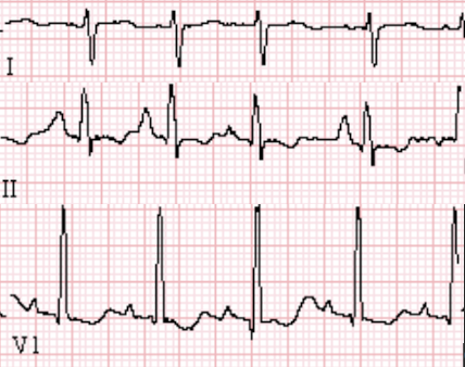 Right Ventricular Hypertrophy - ECG Made Simple