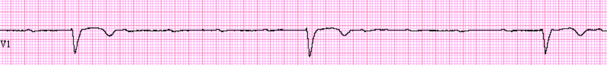 Ventricular Escape Rhythm Ecg Made Simple