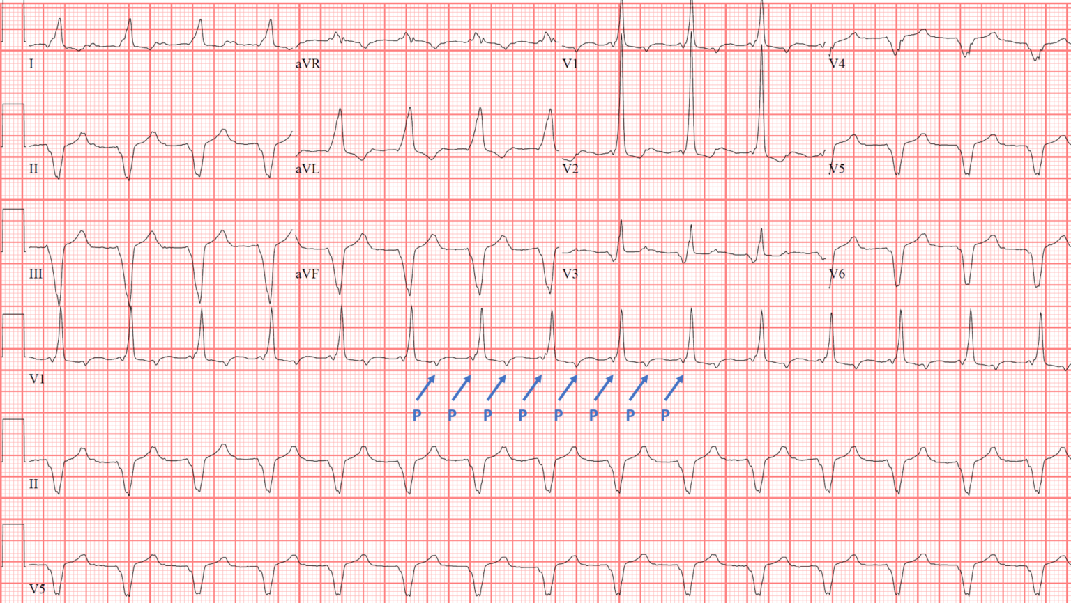 Case 1: A 53-Year-Old Man with Shortness of Breath - ECG Made Simple