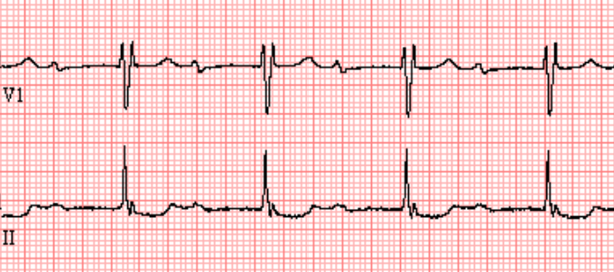 First Degree AV Block - ECG Made Simple