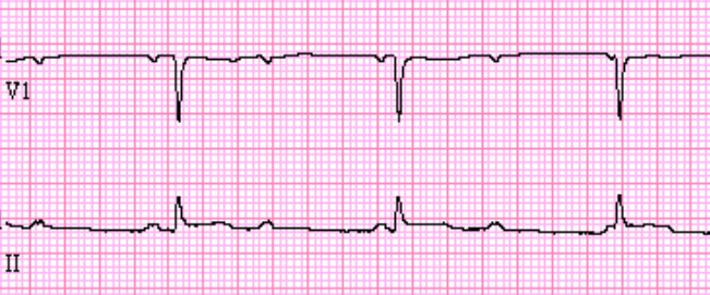 Junctional Escape Rhythm - ECG Made Simple