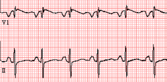 left-atrial-enlargement-ecg-made-simple