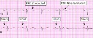 Premature Atrial Complex, Non-Conducted - ECG Made Simple