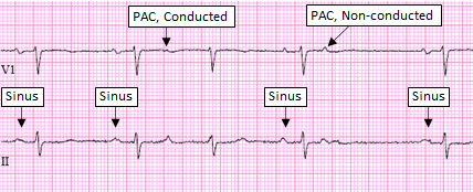 Premature Atrial Complex, Non-Conducted - ECG Made Simple