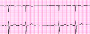 Sinoatrial Block - Ecg Made Simple