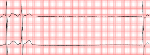 Sinus Arrest - ECG Made Simple