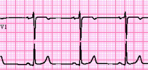 Sinus R1 Sinus Rhythm - ECG Made Simple