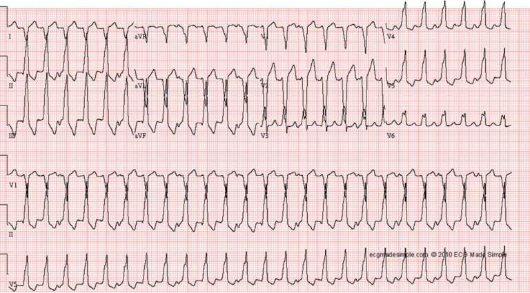 Case 90: A 45 Year-Old Man in the ER with Palpitations - ECG Made Simple