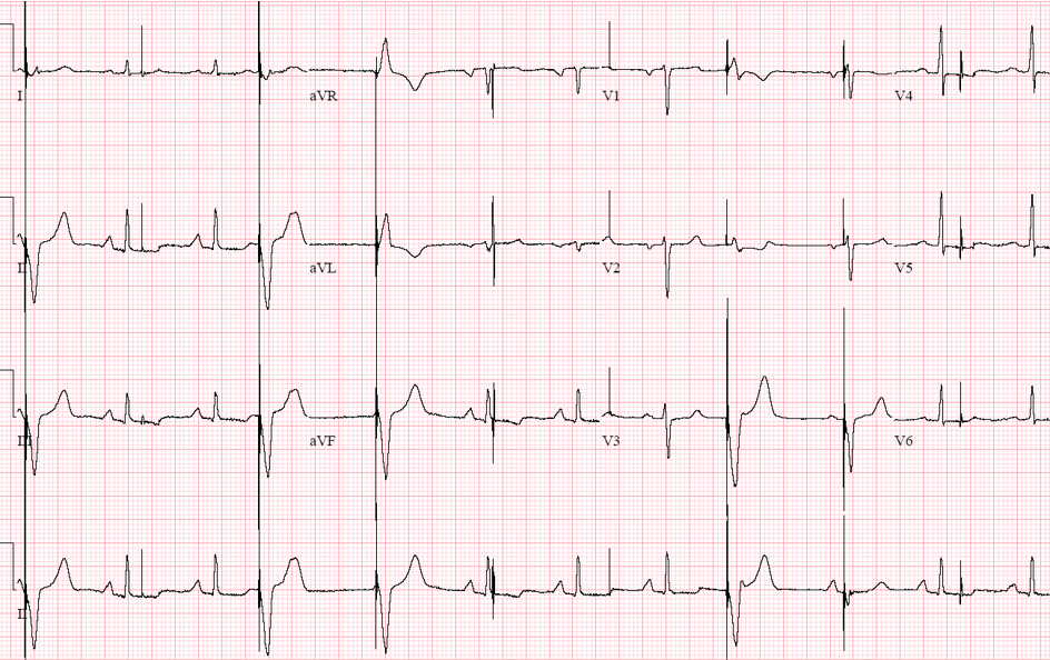 Case 4: An 81-Year-Old Man in the Pacemaker Clinic - ECG Made Simple