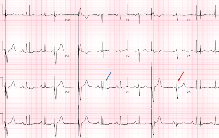 Case 4: An 81-Year-Old Man in the Pacemaker Clinic - ECG Made Simple