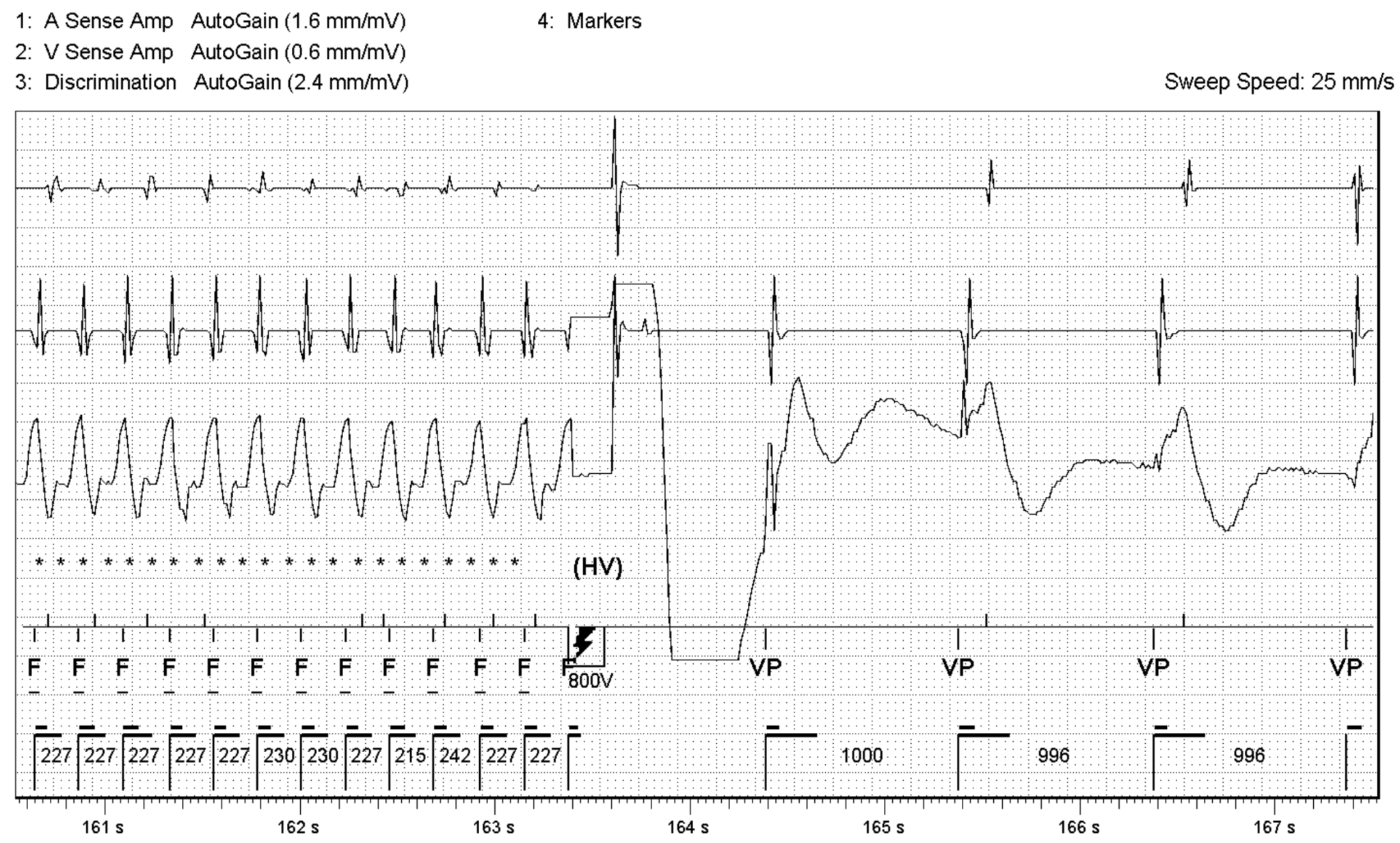Case 2: A 56 Year-Old Man in the Defibrillator Clinic - ECG Made Simple