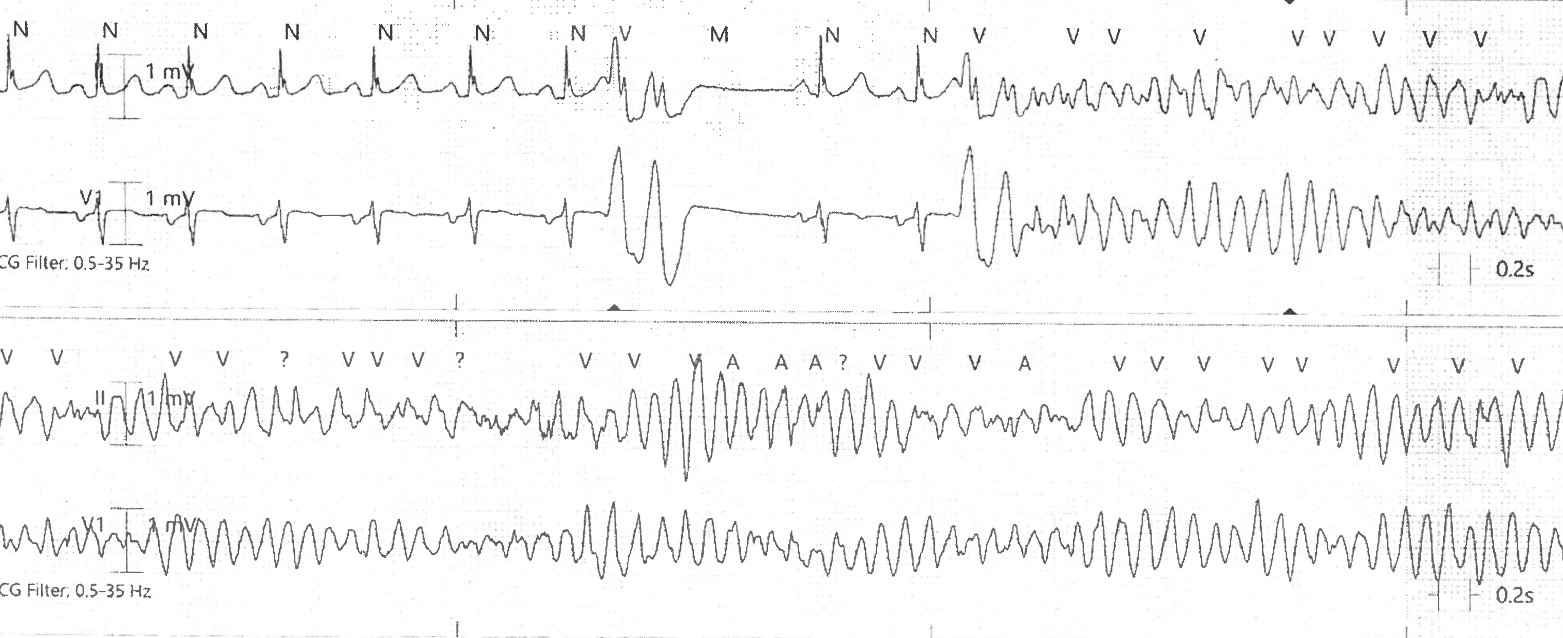 Case 149: A 72 Year-Old Man in the Medical-Surgical ICU - ECG Made Simple