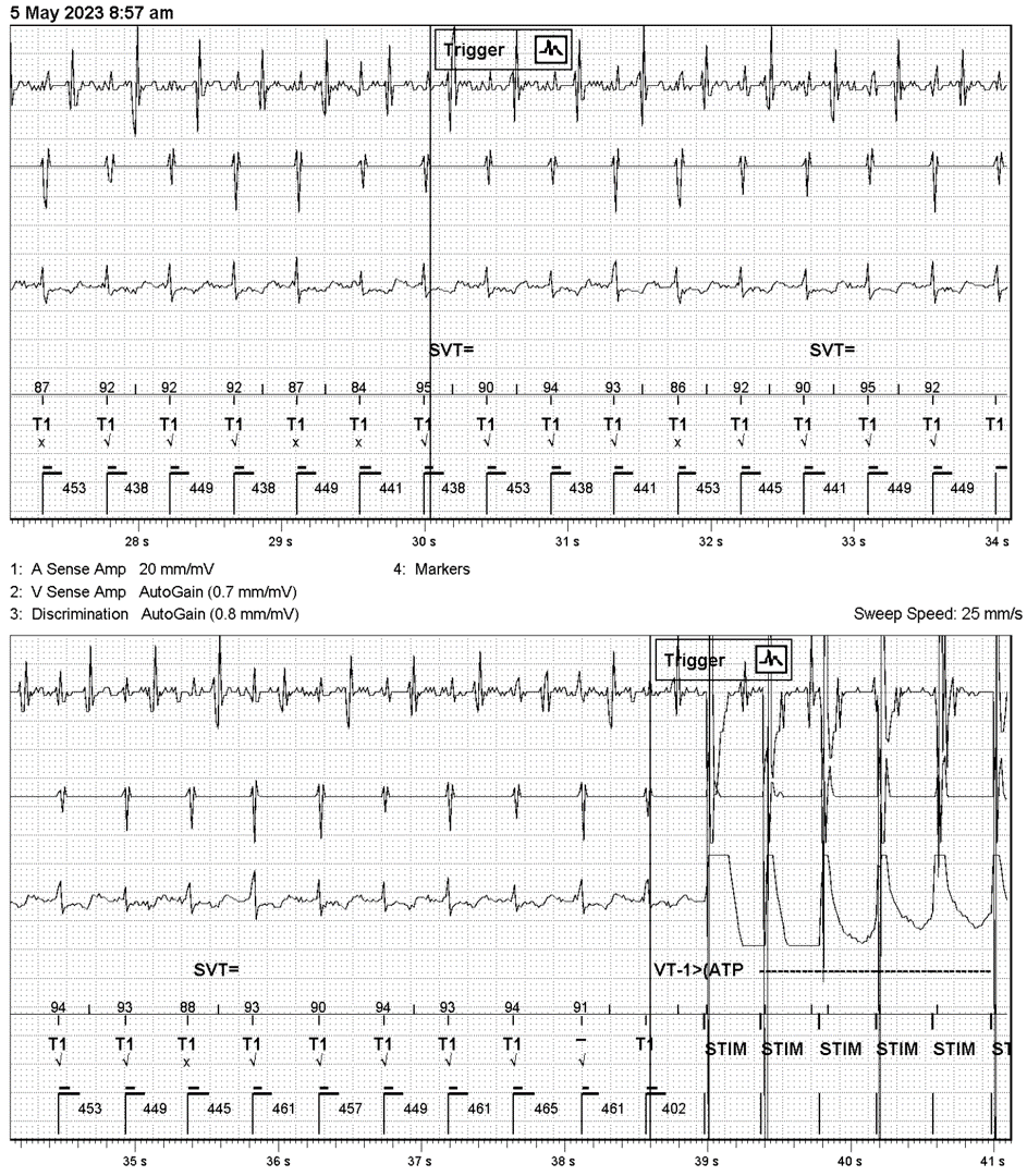 Case 5: A 78 Year-Old Man in the Defibrillator Clinic - ECG Made Simple